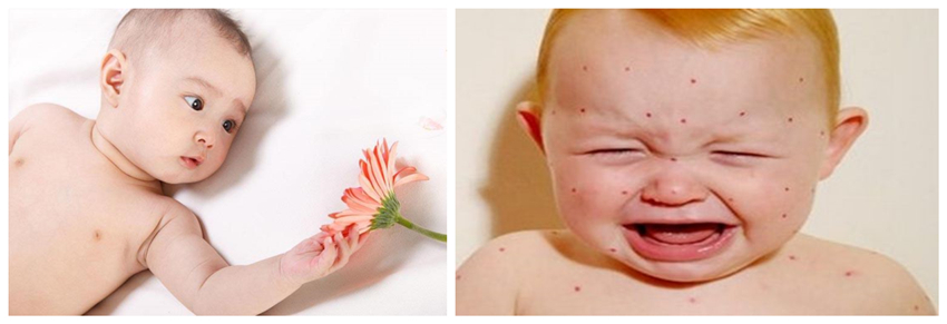 兒童濕疹反反復復，您有在家安裝家用除濕產品嗎？